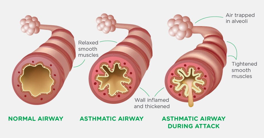 This illustration shows what happens during an asthma attack or flare-up.