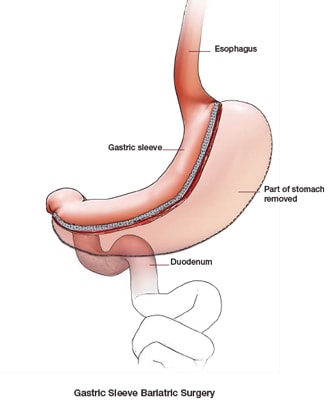 illustration of gastric sleeve procedure