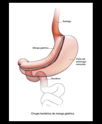 illustration of gastric sleeve procedure