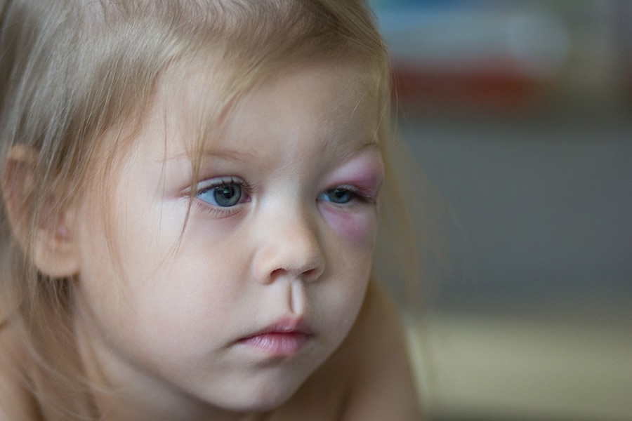 Toddler age girl with a black eye